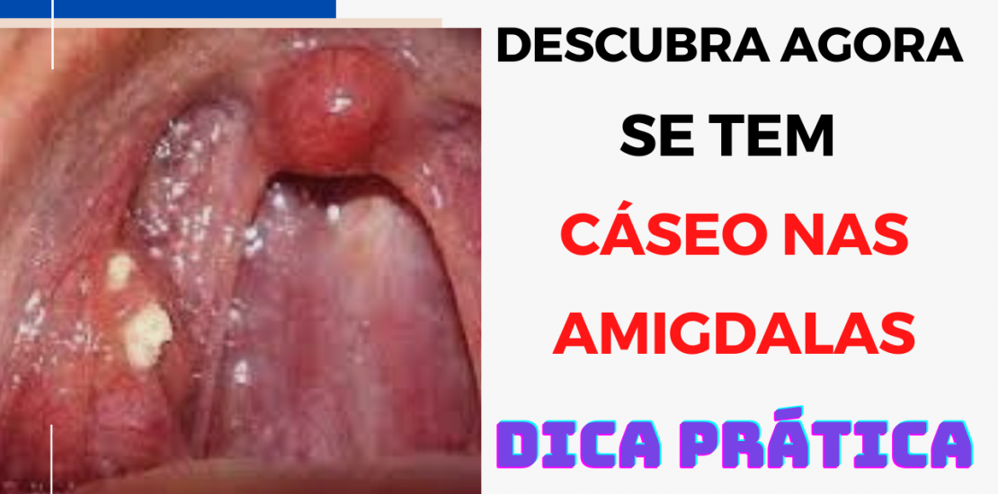 caso amigdaliano mau hálito gosto ruim na boca massinha fedida pedrinha buraco amigdala